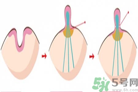 乳頭內(nèi)陷矯正需注意什么？乳頭內(nèi)陷如何預防？