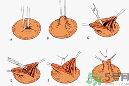 乳頭內陷能不能喂奶？乳頭凹陷怎樣哺乳？