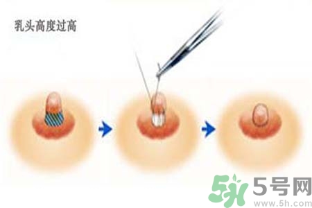 乳頭內陷能不能喂奶？乳頭凹陷怎樣哺乳？