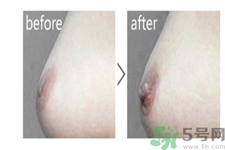 乳頭內陷能不能喂奶？乳頭凹陷怎樣哺乳？