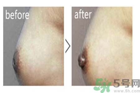 乳頭內陷可以用吸奶器嗎？乳頭內陷能不能用吸奶器？