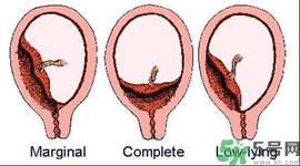 陰道出血和什么有關(guān)？陰道出血的應急措施有哪些？