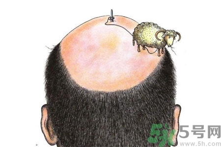 頭發(fā)稀少的原因是什么？如何預(yù)防禿頂?shù)陌l(fā)生？