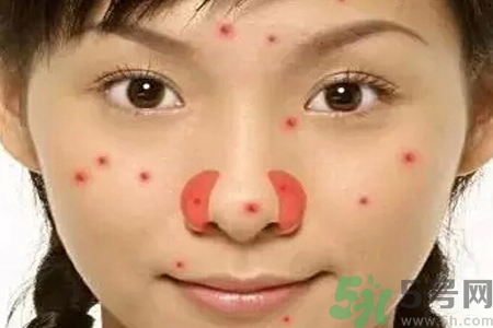 鼻翼長痘痘怎么回事？鼻翼長痘痘的原因是什么？