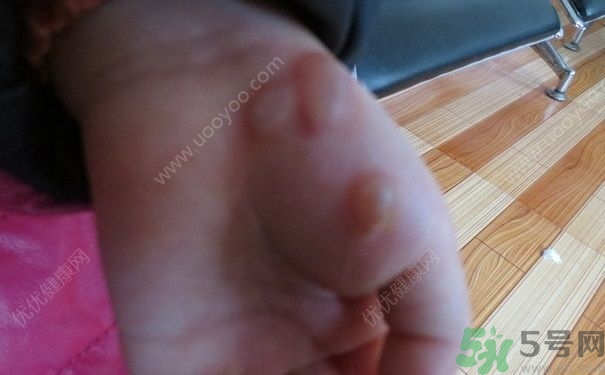 15歲還會得手足口病嗎？手足口病的癥狀有哪些？