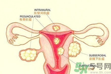 ?子宮移位怎么治療？子宮移位能懷孕嗎？