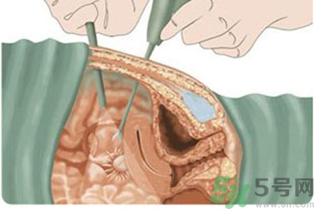子宮移位的原因是什么？子宮移位的癥狀有哪些？