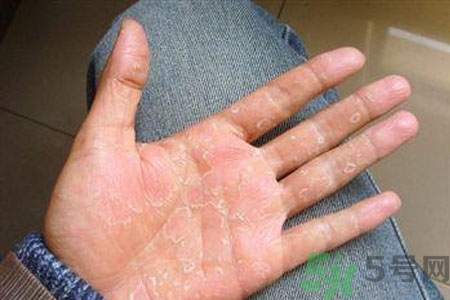?手掌脫皮的危害有哪些？如何預防手掌脫皮？