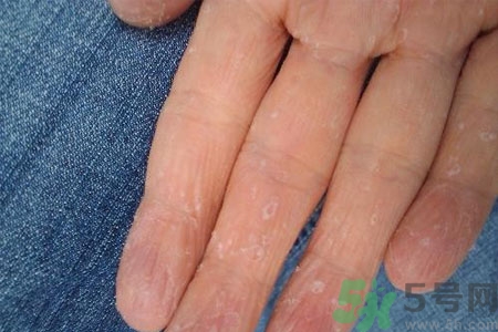 ?手掌脫皮的危害有哪些？如何預防手掌脫皮？