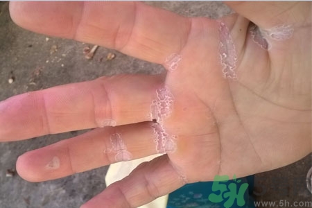 ?手掌脫皮的危害有哪些？如何預防手掌脫皮？