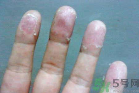 手脫皮是什么原因？手脫皮的治療方法是什么？