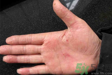 手脫皮是什么原因？手脫皮的治療方法是什么？