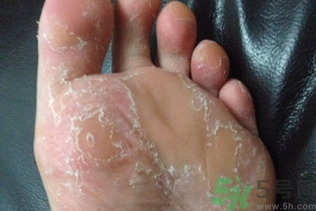 腳脫皮是怎么回事？腳脫皮怎么辦？