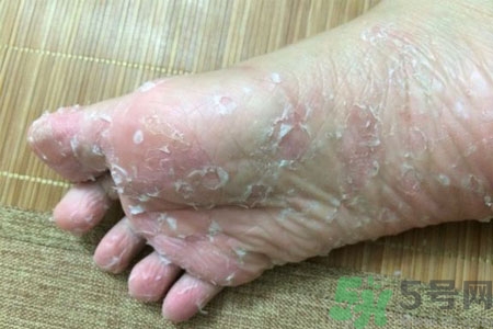 腳脫皮的治療方法有哪些？如何預(yù)防腳脫皮？