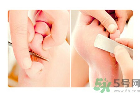 雞眼如何去除？腳上長了雞眼怎么治療？