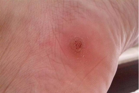 雞眼如何去除？腳上長了雞眼怎么治療？