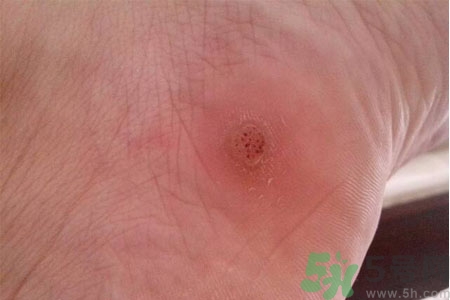 腳上長雞眼是怎么回事？腳上長雞眼是怎么辦？