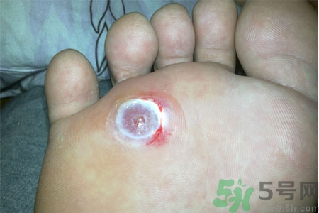 雞眼怎么能徹底根治？如何預防腳上長雞眼？