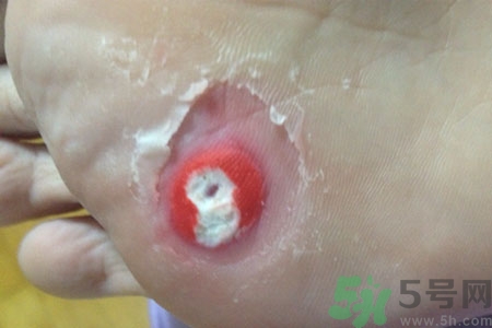 雞眼怎么能徹底根治？如何預防腳上長雞眼？