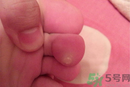 雞眼怎么能徹底根治？如何預防腳上長雞眼？