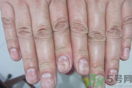 孩子手指甲凹凸不平是什么原因？手指甲凹凸不平的原因是什么？