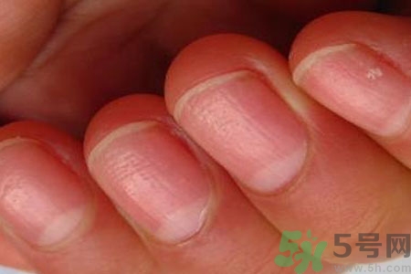 手指甲凹凸不平是怎么回事？如何預防手指甲凹凸不平？