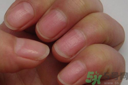 手指甲凹凸不平是怎么回事？如何預防手指甲凹凸不平？