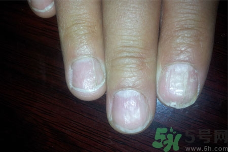 手指甲凹凸不平是怎么回事？如何預防手指甲凹凸不平？