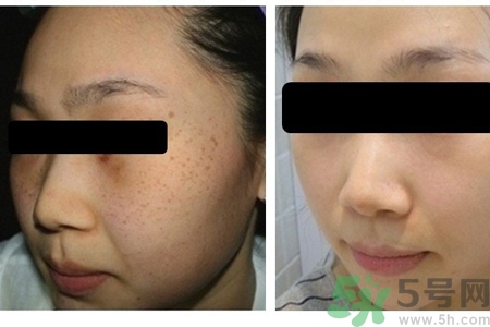 激光縮毛孔多少錢一次？激光縮毛孔一個(gè)療程多少錢？