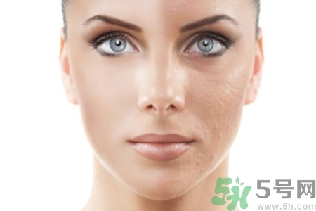 激光縮毛孔多少錢一次？激光縮毛孔一個(gè)療程多少錢？