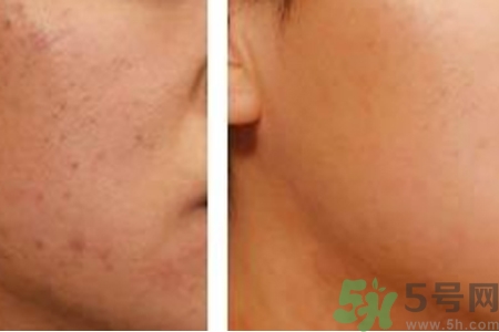 毛孔粗大的原因是什么？激光可以改善毛孔粗大嗎？