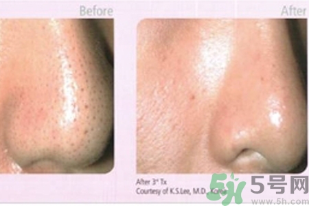 毛孔粗大的原因是什么？激光可以改善毛孔粗大嗎？