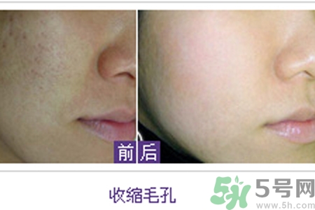 毛孔粗大的原因是什么？激光可以改善毛孔粗大嗎？