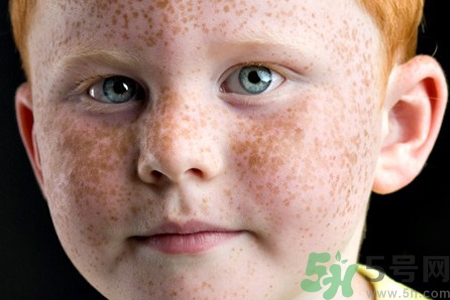 臉上長雀斑吃什么好？有雀斑不能吃什么？