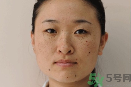 臉上長雀斑吃什么好？有雀斑不能吃什么？
