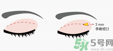 提眉術(shù)后多久可以恢復(fù)？提眉術(shù)后全過程照片