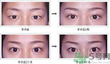 提眉術(shù)后多久可以恢復(fù)？提眉術(shù)后全過程照片