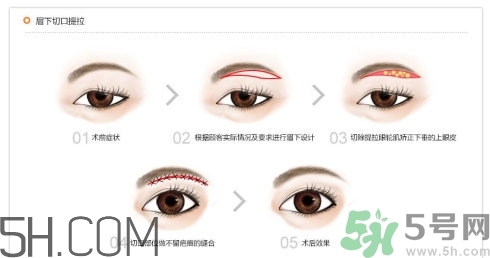 切眉手術(shù)后老得快嗎？切眉能保持多久？