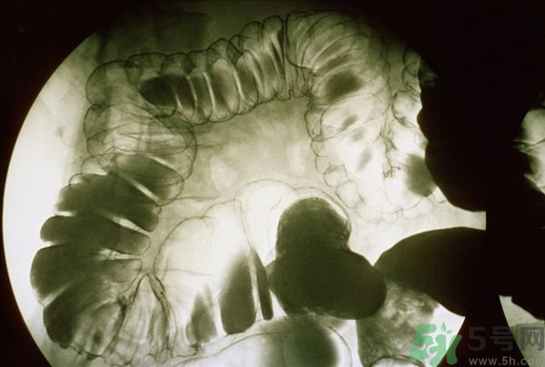 腸炎肚子疼怎么辦？腸炎肚子疼怎么緩解？