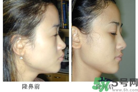 玻尿酸隆鼻的危害有哪些？玻尿酸隆鼻的副作用是什么？