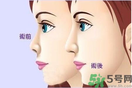 玻尿酸隆鼻的缺點(diǎn)是什么？玻尿酸隆鼻的優(yōu)點(diǎn)有哪些？