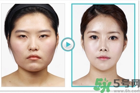 玻尿酸隆鼻的缺點(diǎn)是什么？玻尿酸隆鼻的優(yōu)點(diǎn)有哪些？