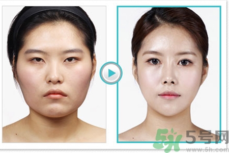 玻尿酸隆鼻和手術(shù)隆鼻的區(qū)別是什么？