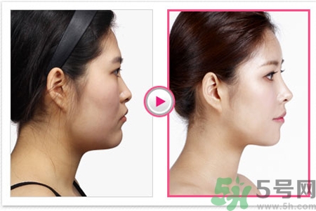 玻尿酸隆鼻和手術(shù)隆鼻的區(qū)別是什么？