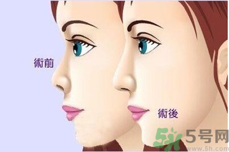 玻尿酸隆鼻和手術(shù)隆鼻的區(qū)別是什么？