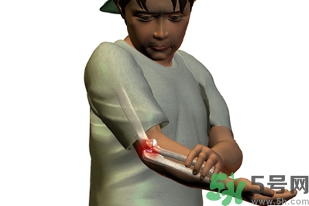 幼年關(guān)節(jié)炎的好發(fā)年齡？幼年關(guān)節(jié)炎別輕易忽視