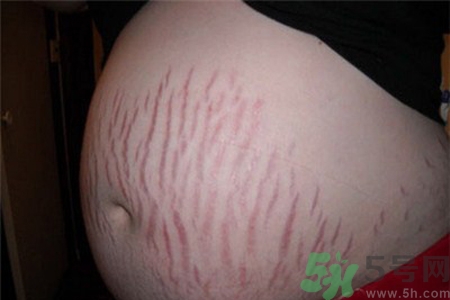 妊娠紋癢是怎么回事？妊娠紋癢怎么辦？