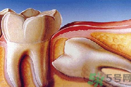 拔智齒一顆多少錢？拔除智齒收費(fèi)多少？