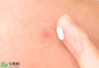 獅王祛痘膏怎么樣？獅王祛痘好用嗎？