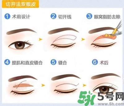 雙眼皮手術(shù)哪種最好？割雙眼皮后注意些什么？
